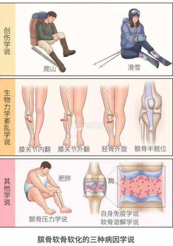 髌骨软骨软化症症状_走路时为什么膝盖会突然软一下_髌骨软化症原因