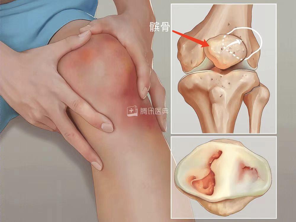 髌骨软化症原因_髌骨软骨软化症症状_走路时为什么膝盖会突然软一下