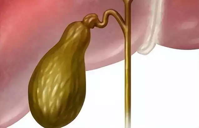 医生揭秘：多数胆囊癌患者患病原因，很多人却不当回事