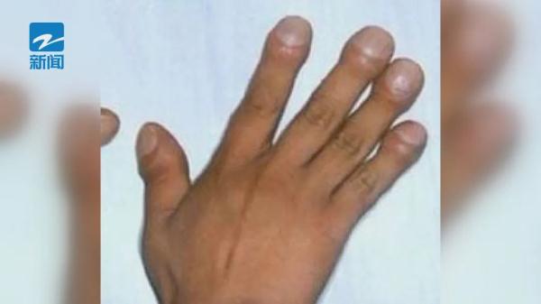 小伙一年长高35厘米!医生提醒:这些日常变化要注意