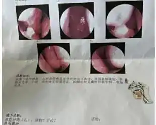 极其罕见！男子鼻子里竟长了颗牙？
