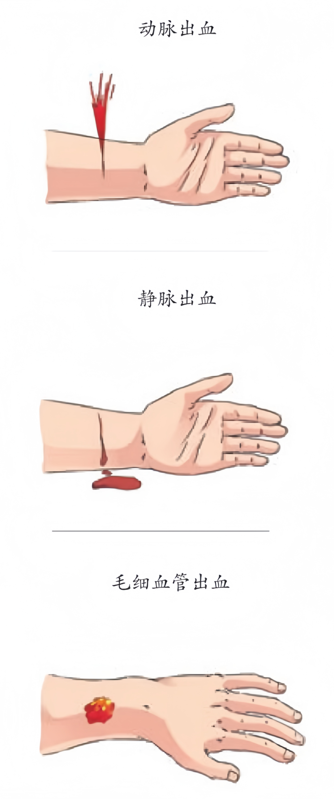 健康小科普：正确止血方法，关键时刻能救命！