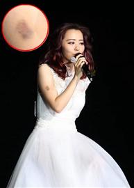 舞台成明星事故高发地：张靓颖摔伤 黄家驹坠亡