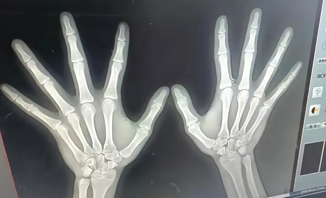 5岁半宝宝身高体重_10岁半男孩身高增长_骨龄提前发育