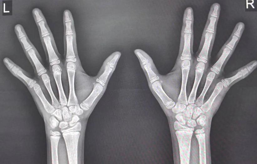 5岁半宝宝身高体重_骨龄评估预测身高_孩子生长板闭合判断