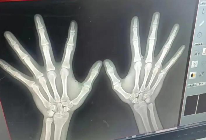 孩子生长板闭合判断_骨龄评估预测身高_5岁半宝宝身高体重