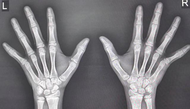 生长激素使用时机_拍AI骨龄_5岁半宝宝身高体重