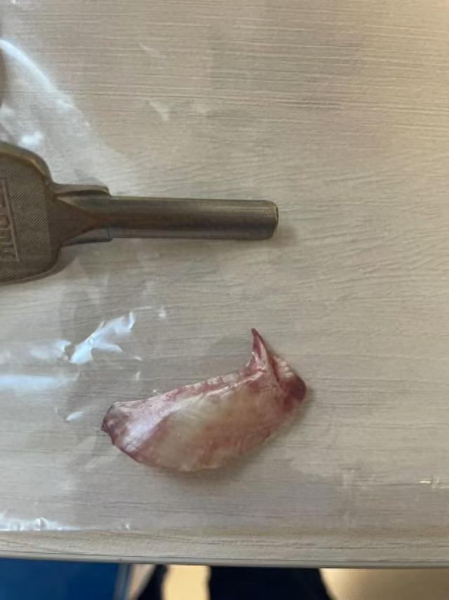 男子吃红烧鱼不慎被鱼刺卡喉，尝试猛吞蔬菜狂喝水等方式自救后，鱼刺竟直扎心脏！这些操作很危险