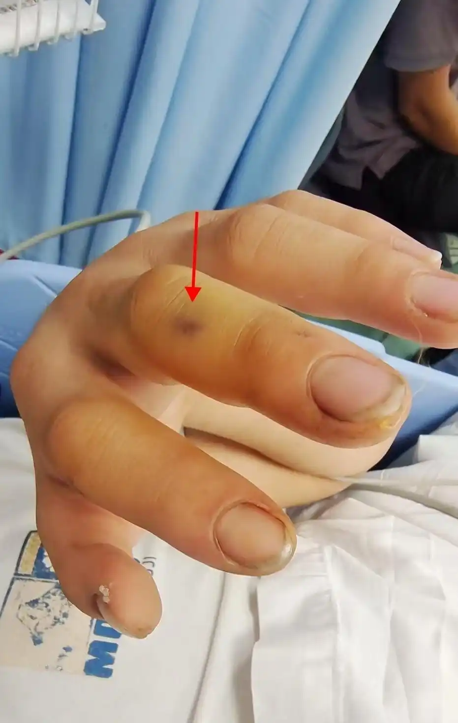 剧毒！深圳00后小伙徒手抓蛇反被咬