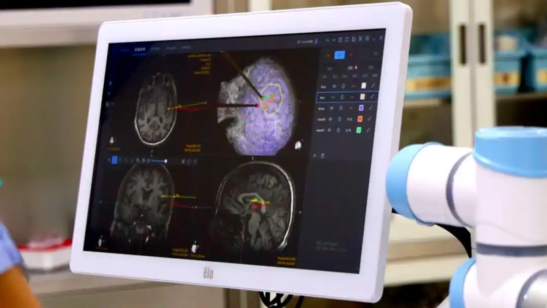 北脑一号 柔性高通量半侵入式无线全植入脑机系统 中文语言脑机接口_脑机接口让渐冻症患者成功自主进食