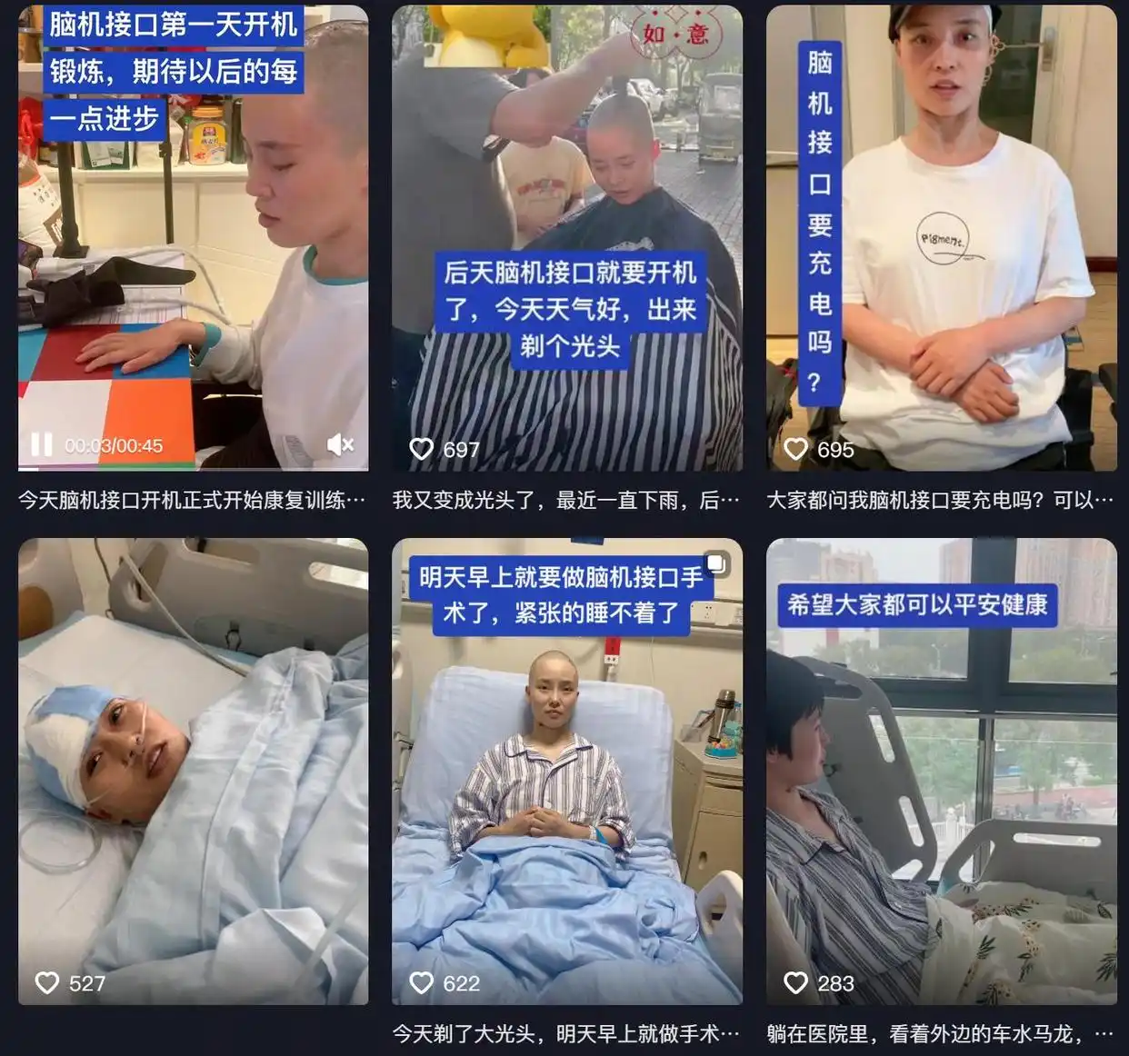 车祸瘫痪脑机接口手术_脑机接口让渐冻症患者成功自主进食_脑机接口意念控制手