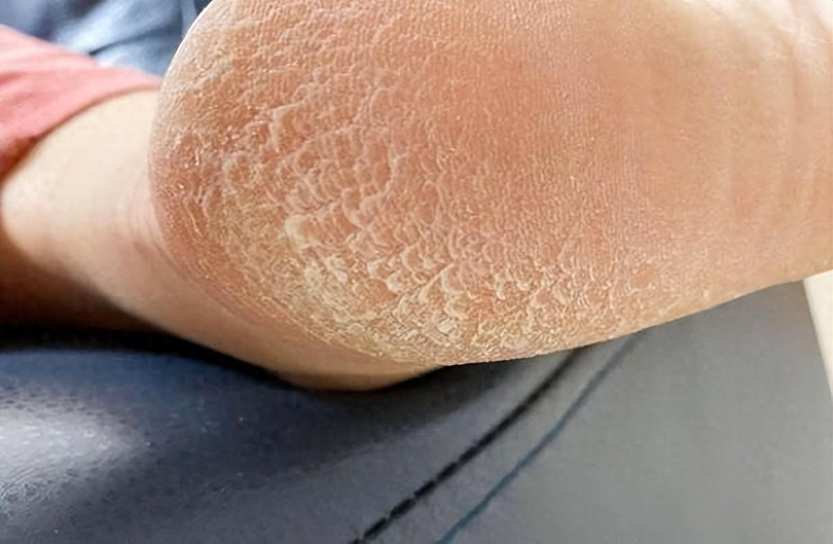 治疗角化型脚气，有这篇就够了！