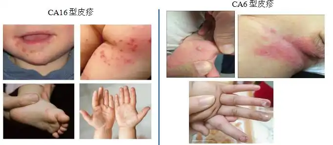河南手足口病CA16型CA6型症状差异_秋季手足口病高发防护措施_河南省疾控发布重要提醒