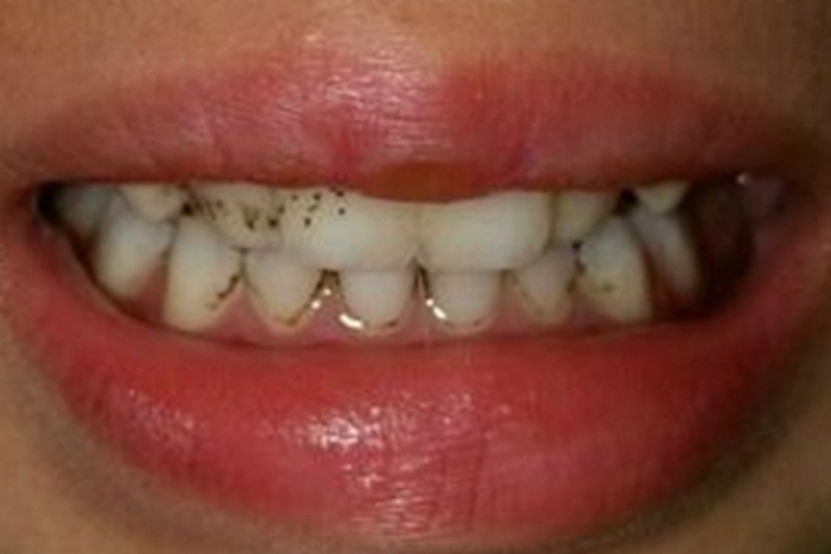 小儿龋齿黑点图片