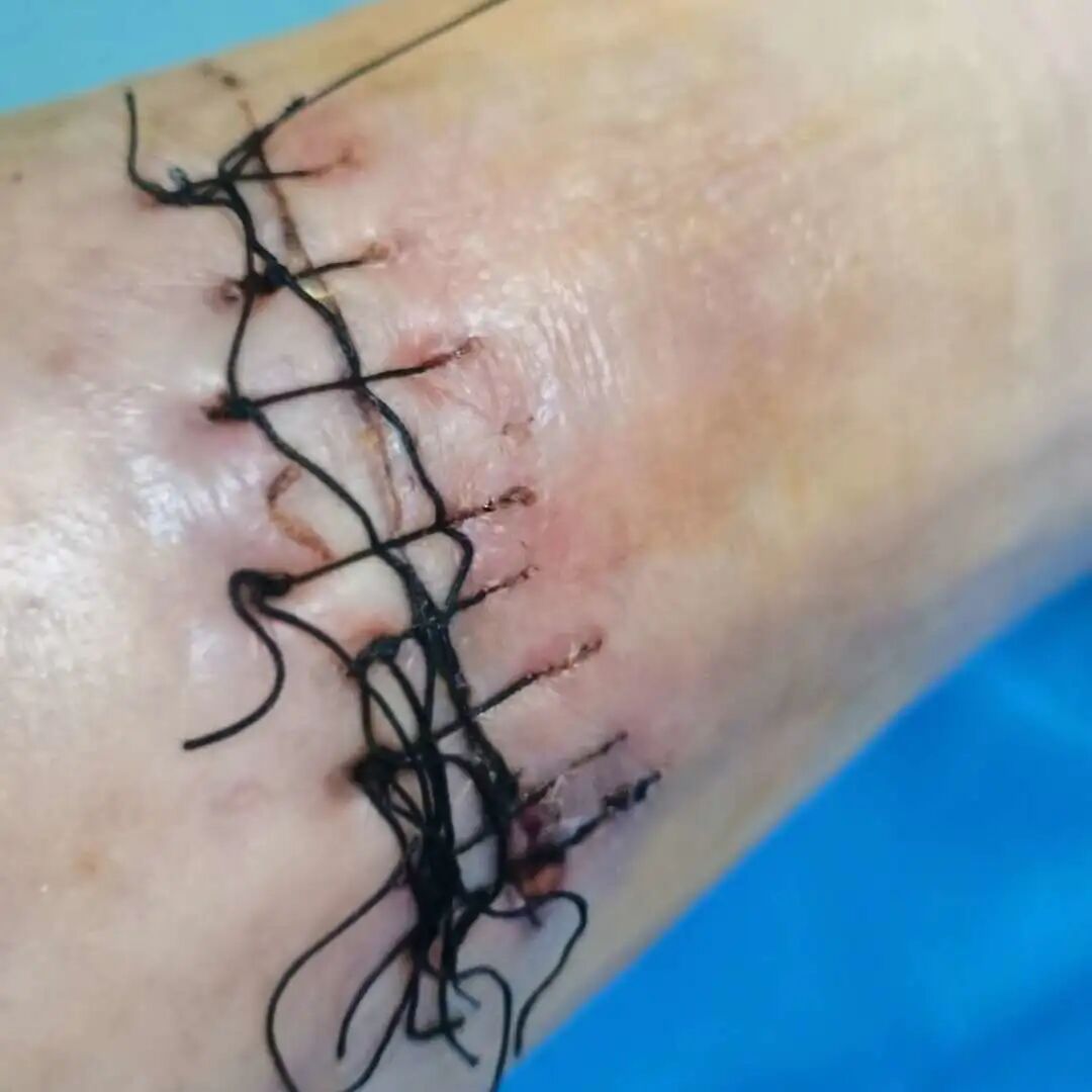 老鼠抓的伤口图片_被宠物抓伤处理方法_狂犬疫苗注射指南