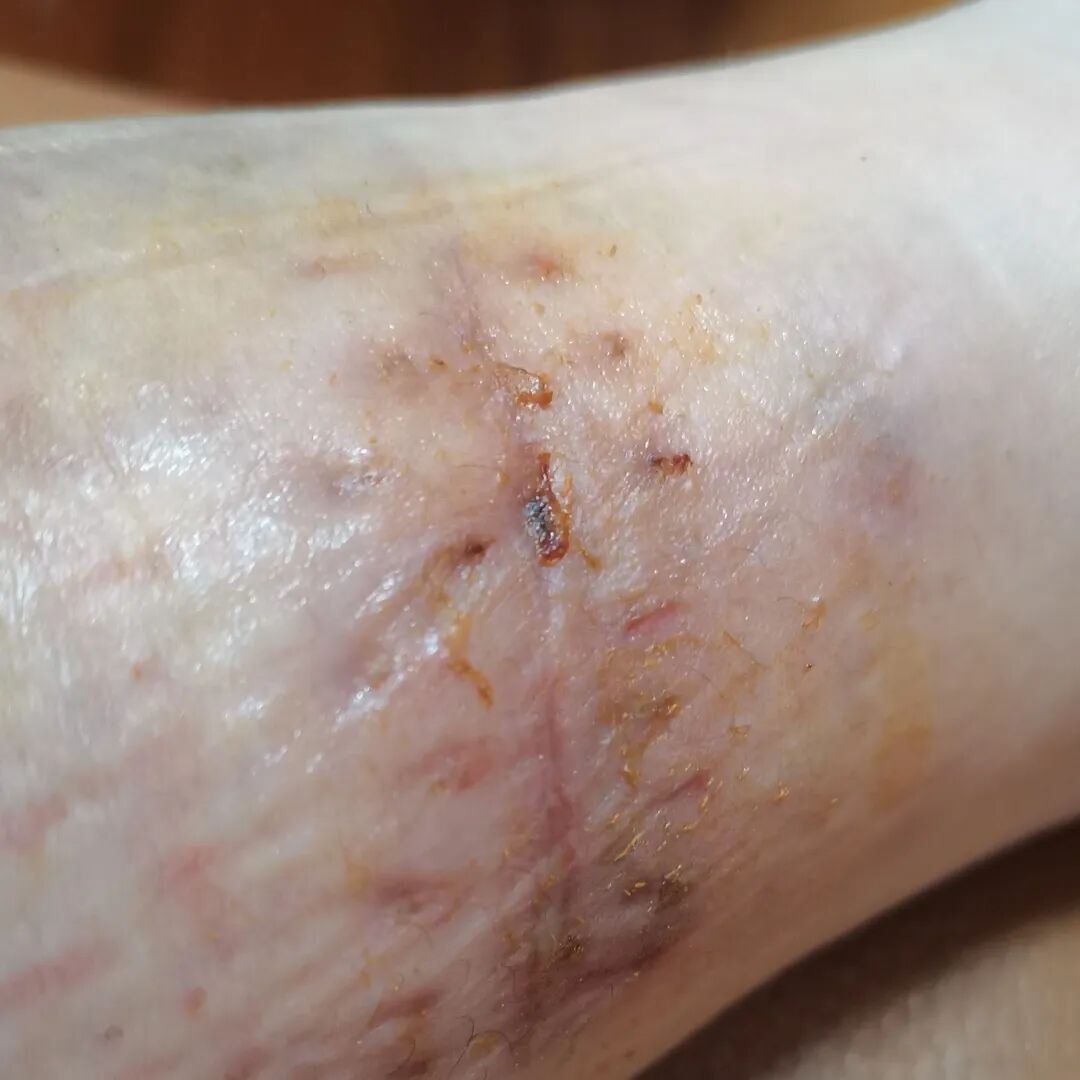 狂犬疫苗注射指南_老鼠抓的伤口图片_被宠物抓伤处理方法