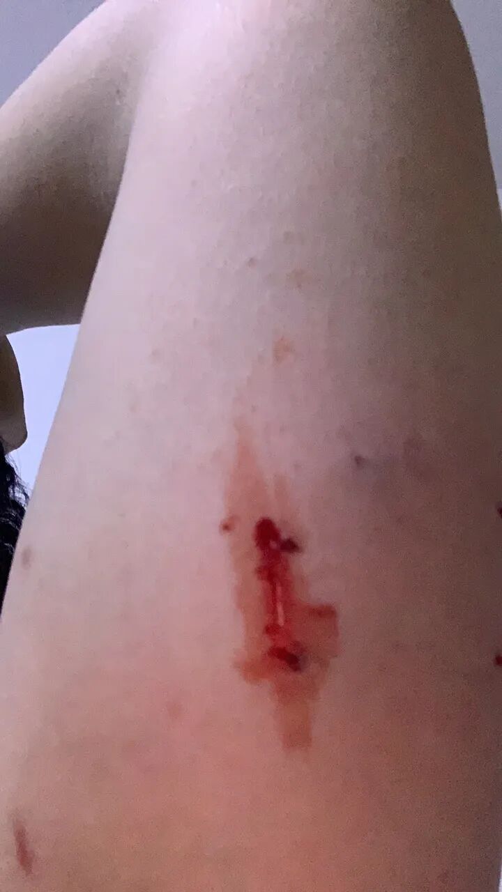 被宠物抓伤处理方法_老鼠抓的伤口图片_狂犬疫苗注射指南