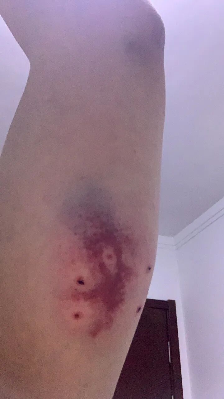 狂犬疫苗注射指南_老鼠抓的伤口图片_被宠物抓伤处理方法