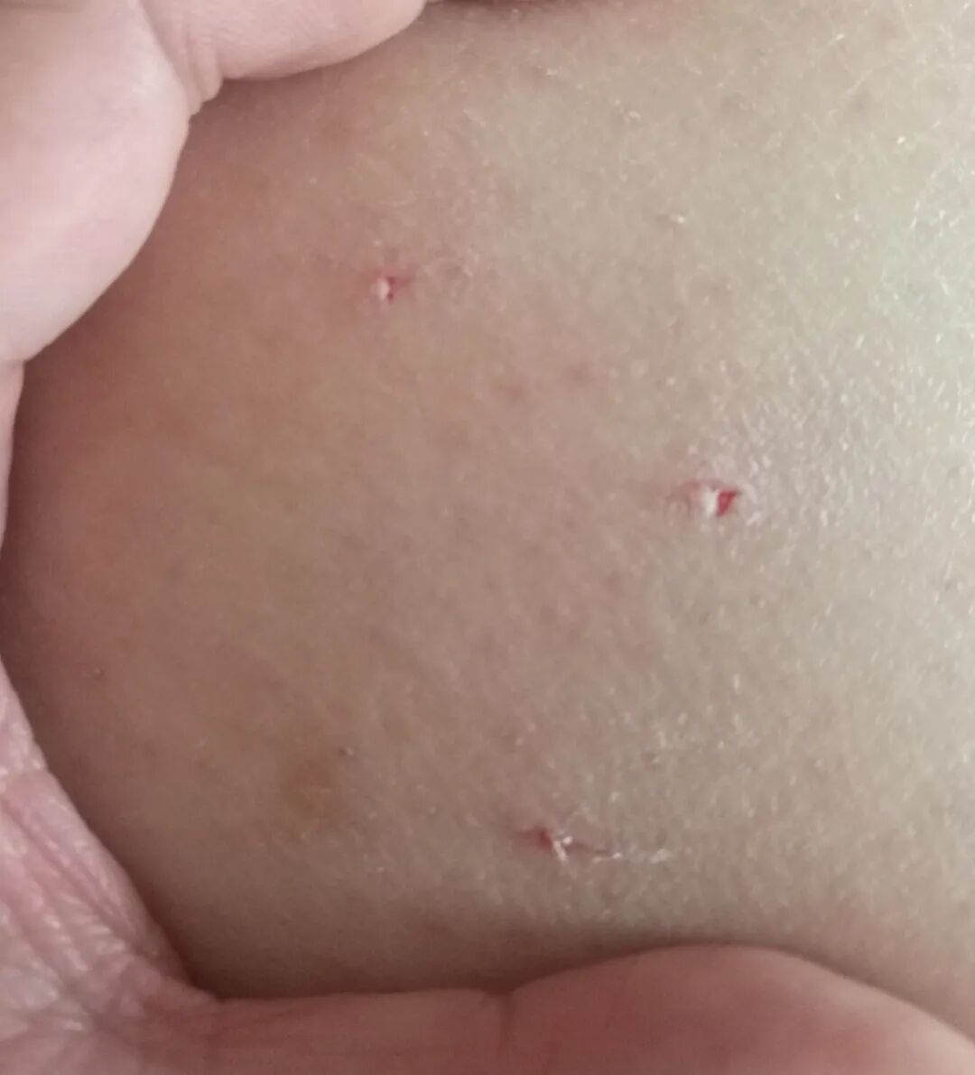 被宠物抓伤处理方法_狂犬疫苗注射指南_老鼠抓的伤口图片