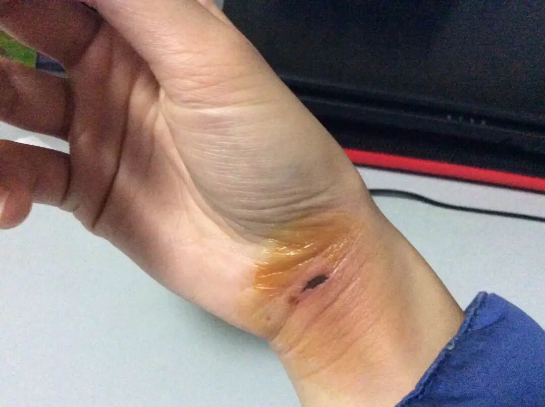 被宠物抓伤处理方法_狂犬疫苗注射指南_老鼠抓的伤口图片