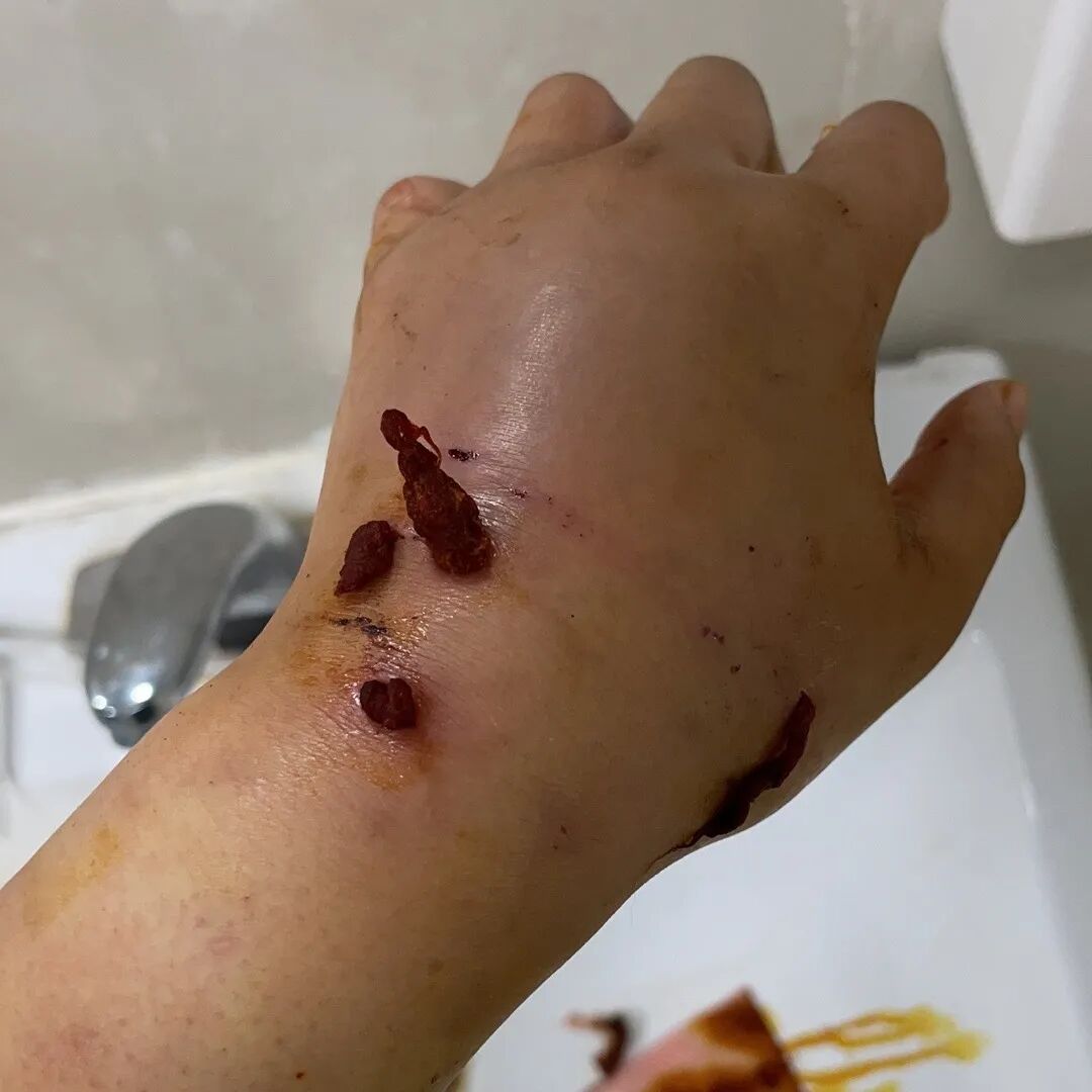 被宠物抓伤处理方法_狂犬疫苗注射指南_老鼠抓的伤口图片