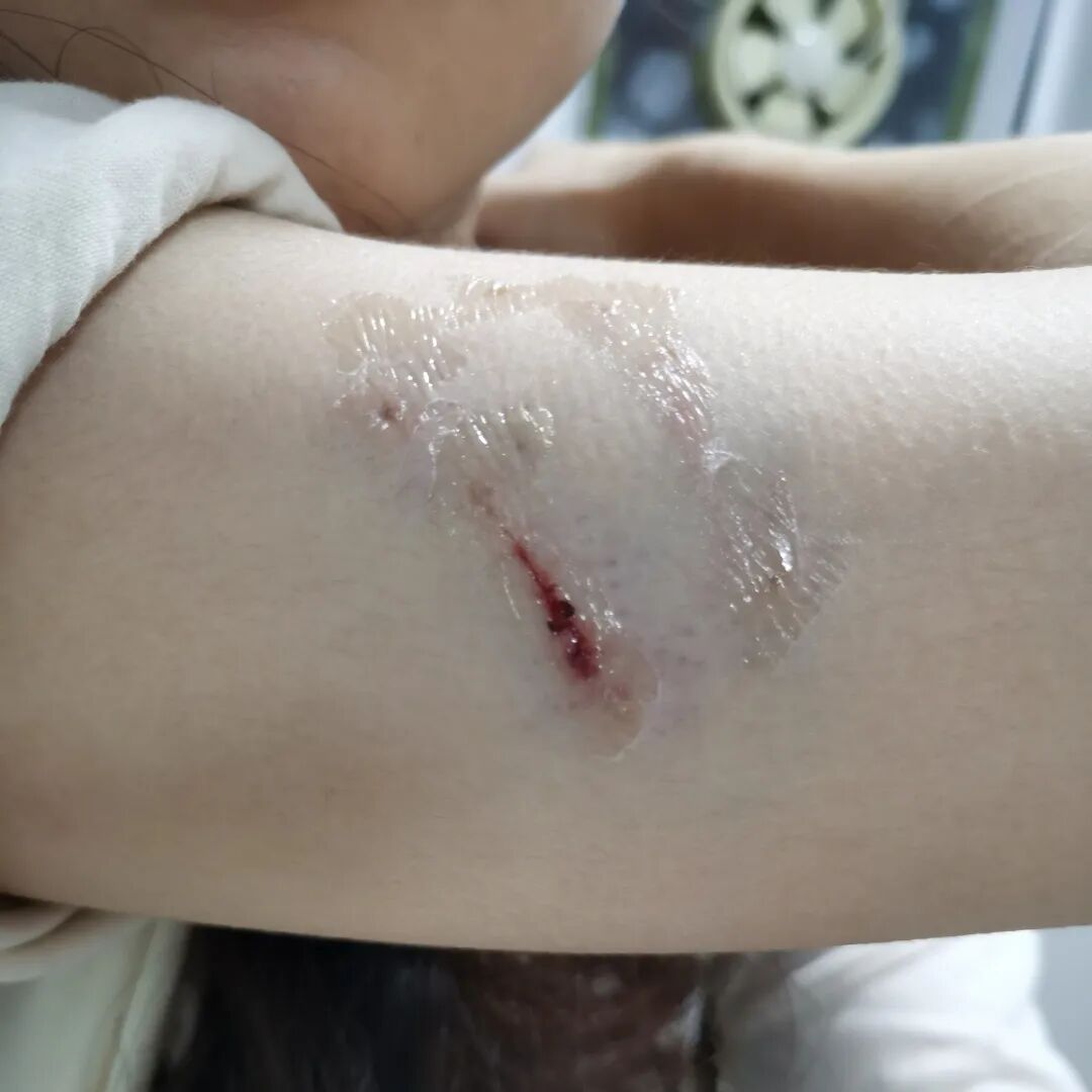 被宠物抓伤处理方法_狂犬疫苗注射指南_老鼠抓的伤口图片