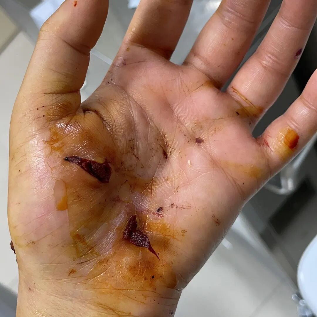 老鼠抓的伤口图片_被宠物抓伤处理方法_狂犬疫苗注射指南