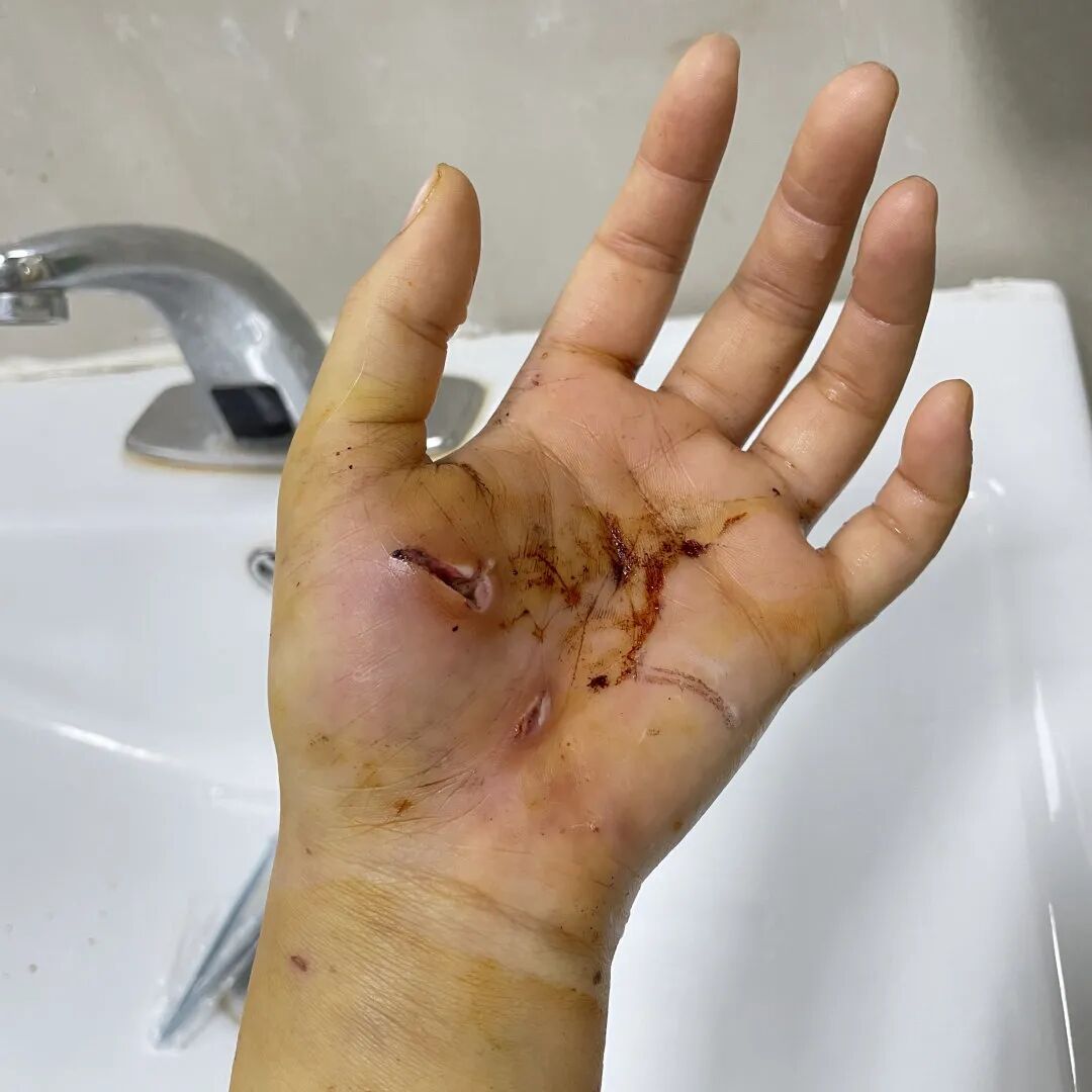 狂犬疫苗注射指南_被宠物抓伤处理方法_老鼠抓的伤口图片