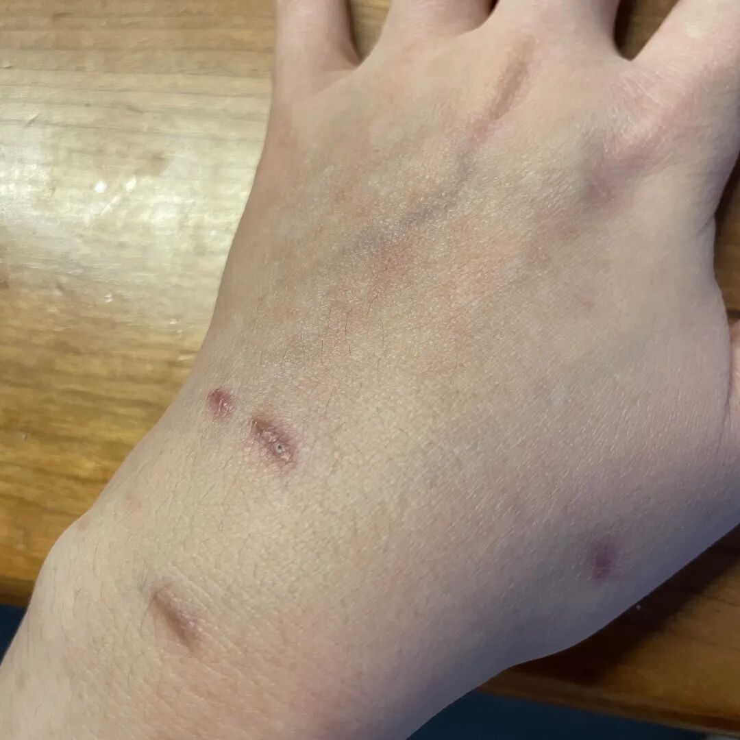 狂犬疫苗注射指南_被宠物抓伤处理方法_老鼠抓的伤口图片