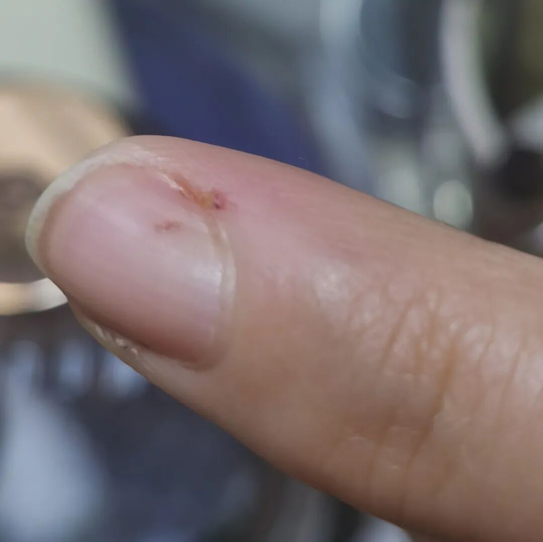 被宠物抓伤处理方法_狂犬疫苗注射指南_老鼠抓的伤口图片