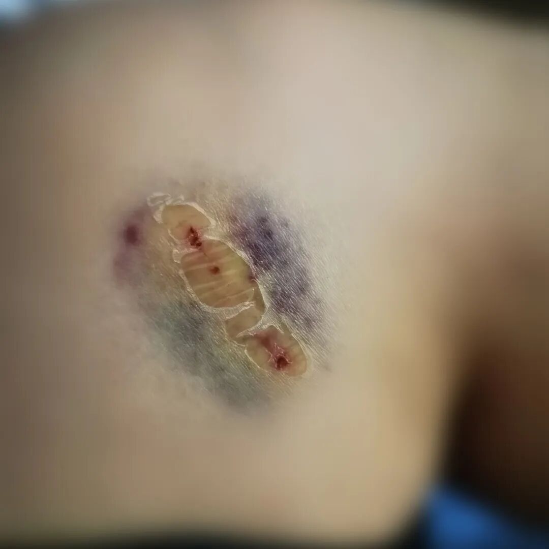 老鼠抓的伤口图片_被宠物抓伤处理方法_狂犬疫苗注射指南