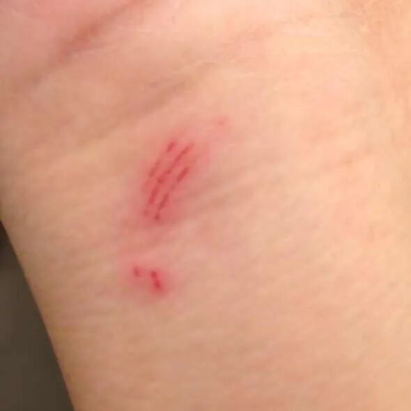 被宠物抓伤处理方法_老鼠抓的伤口图片_狂犬疫苗注射指南