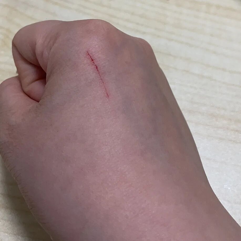 狂犬疫苗注射指南_被宠物抓伤处理方法_老鼠抓的伤口图片