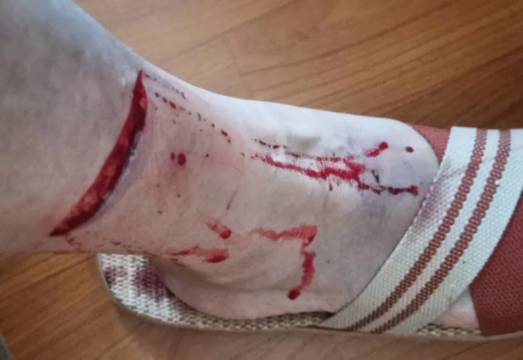 狂犬疫苗注射指南_老鼠抓的伤口图片_被宠物抓伤处理方法