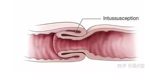 小儿肠套叠