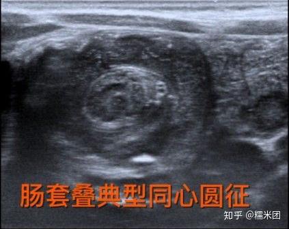 小儿尿失禁原因_小儿肠套叠症状_小儿肠套叠诊断