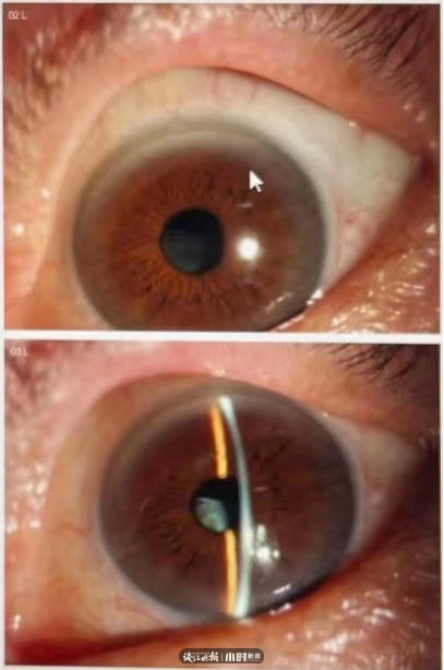 女子用筋膜枪按摩眼睛险失明_筋膜枪眼部使用危害_筋膜枪使用不当造成伤害