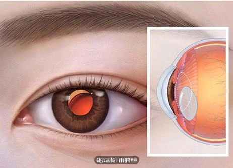 女子用筋膜枪按摩眼睛险失明_筋膜枪眼部使用危害_筋膜枪使用不当造成伤害