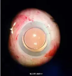 女子用筋膜枪按摩眼睛险失明_筋膜枪眼部使用危害_筋膜枪使用不当造成伤害