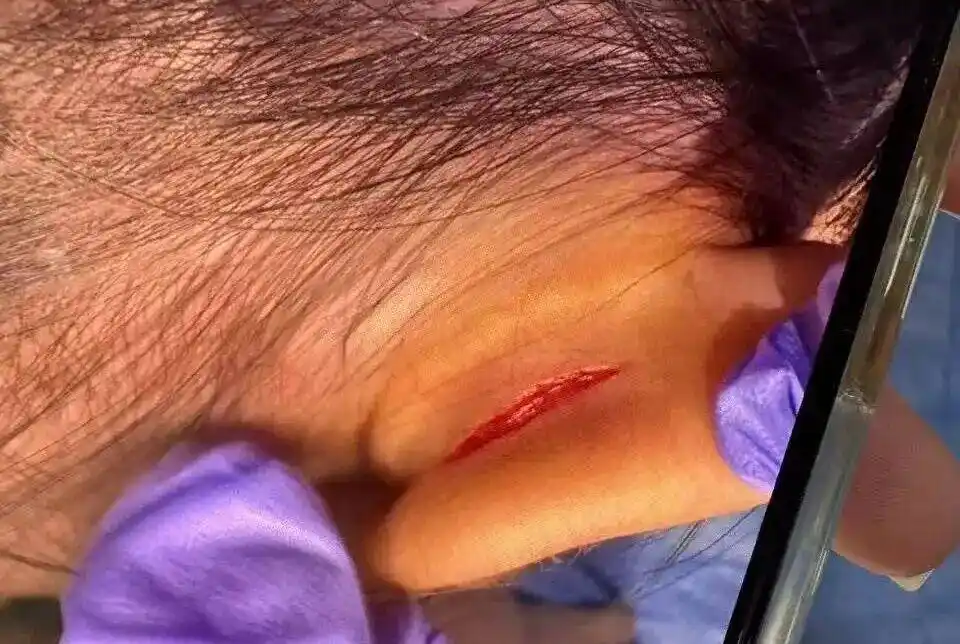 女童上高端托班耳朵疑似撕裂3厘米，家长：唯独出事的教室监控坏了，提及此事孩子就沉默不语