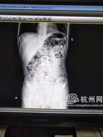 钢珠气枪_暑期儿童意外伤害_暴力玩具伤人事件