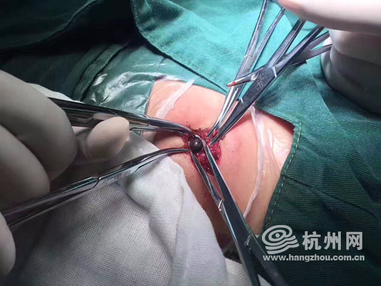 暑期儿童意外伤害_暴力玩具伤人事件_钢珠气枪